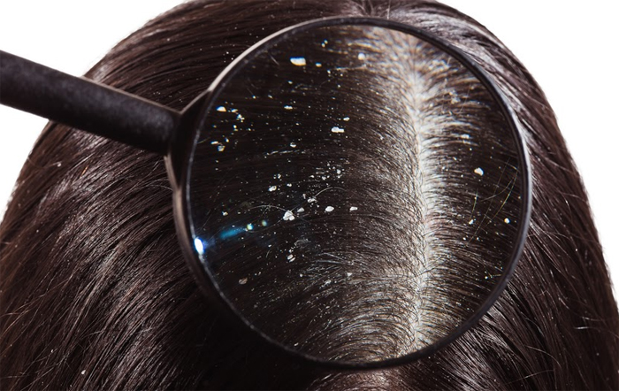 6 Easy Ways to Control Your Dandruff