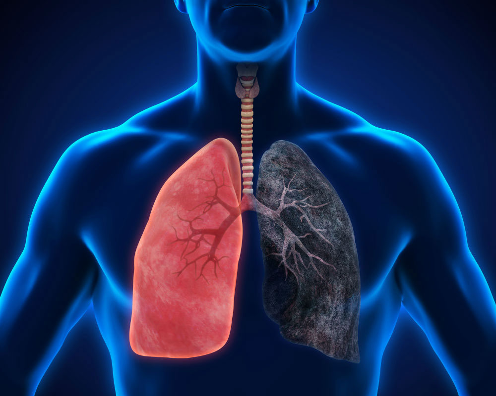 AI can identify lung cancer type