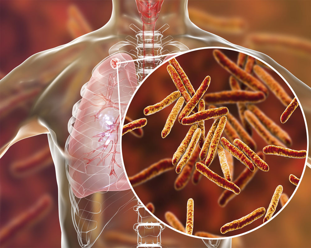 European explorers spread drug-resistant TB to Asia: Study
