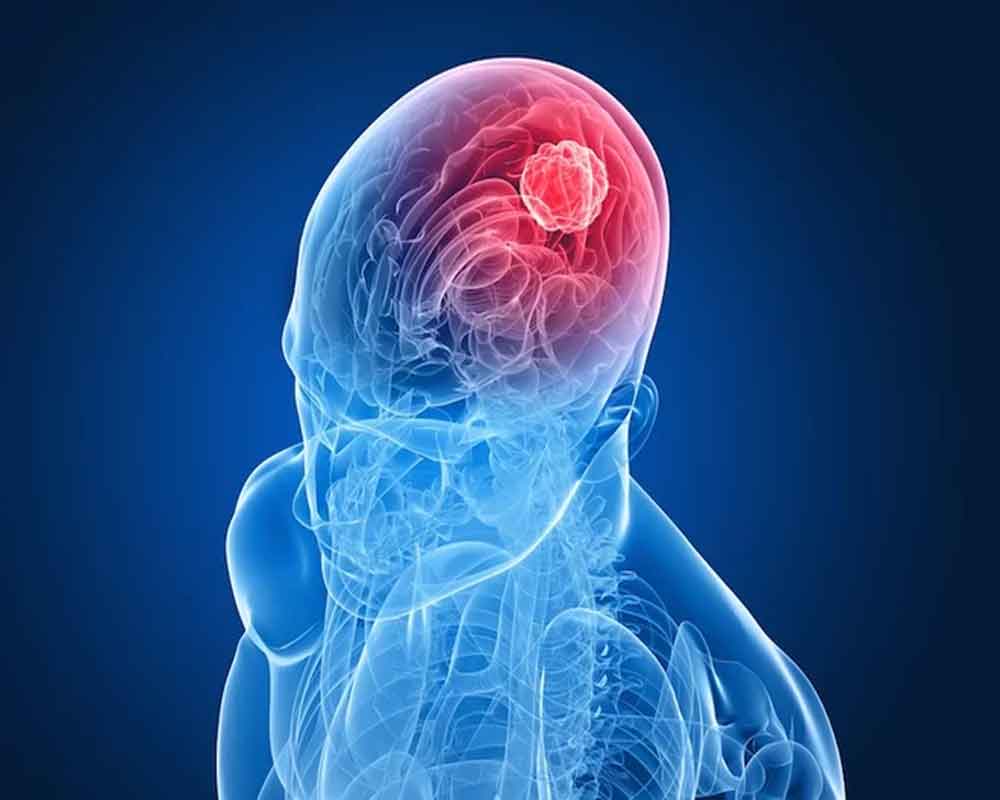 Achilles' heel of aggressive brain cancer found