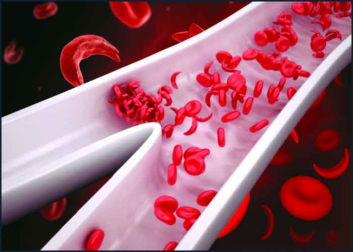 All about sickle cell disease