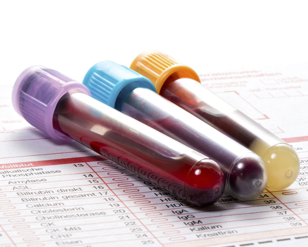 Blood test to spot Alzheimer's before symptoms occur