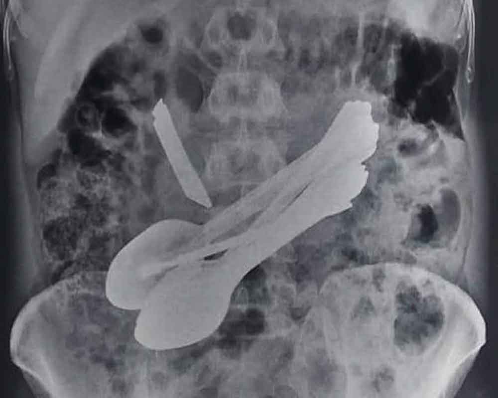 Himachal man with spoons, knife, rod in stomach