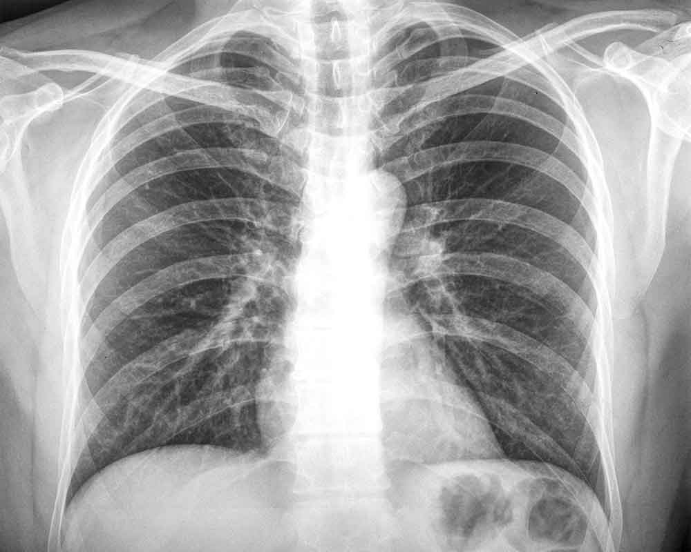 Novel technique could provide early lung cancer diagnosis
