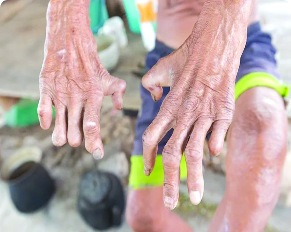 Leprosy image