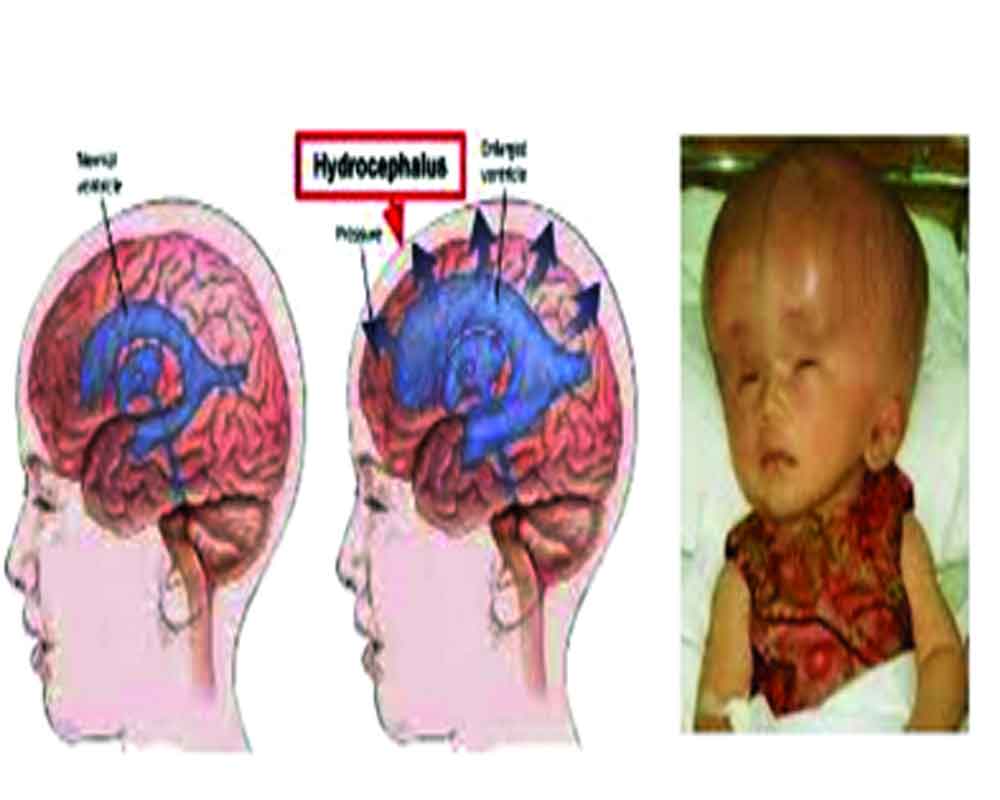 NEURAL TUBE DEFECTS: NIP THEM IN THE BUD