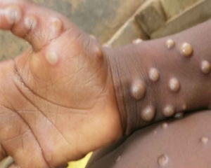 Argentina reports case of monkeypox; man travelled from Spain